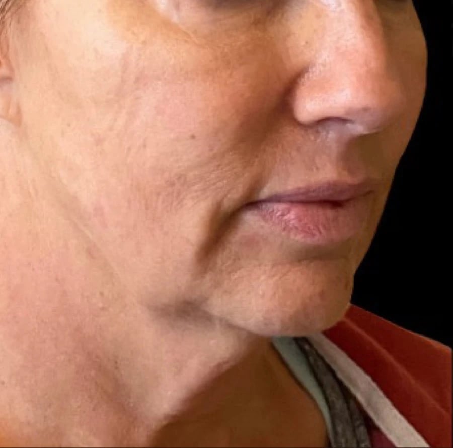 Dermal Fillers before