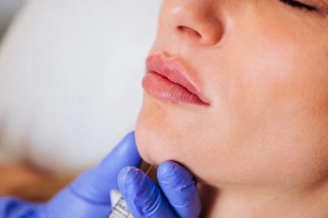 Dermal Fillers