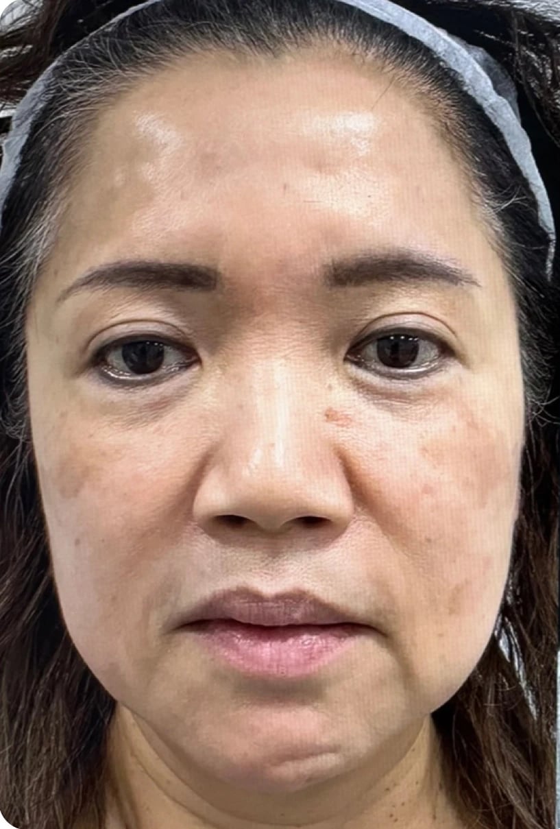 Silhouette Soft / APTOS / PDO Threads before