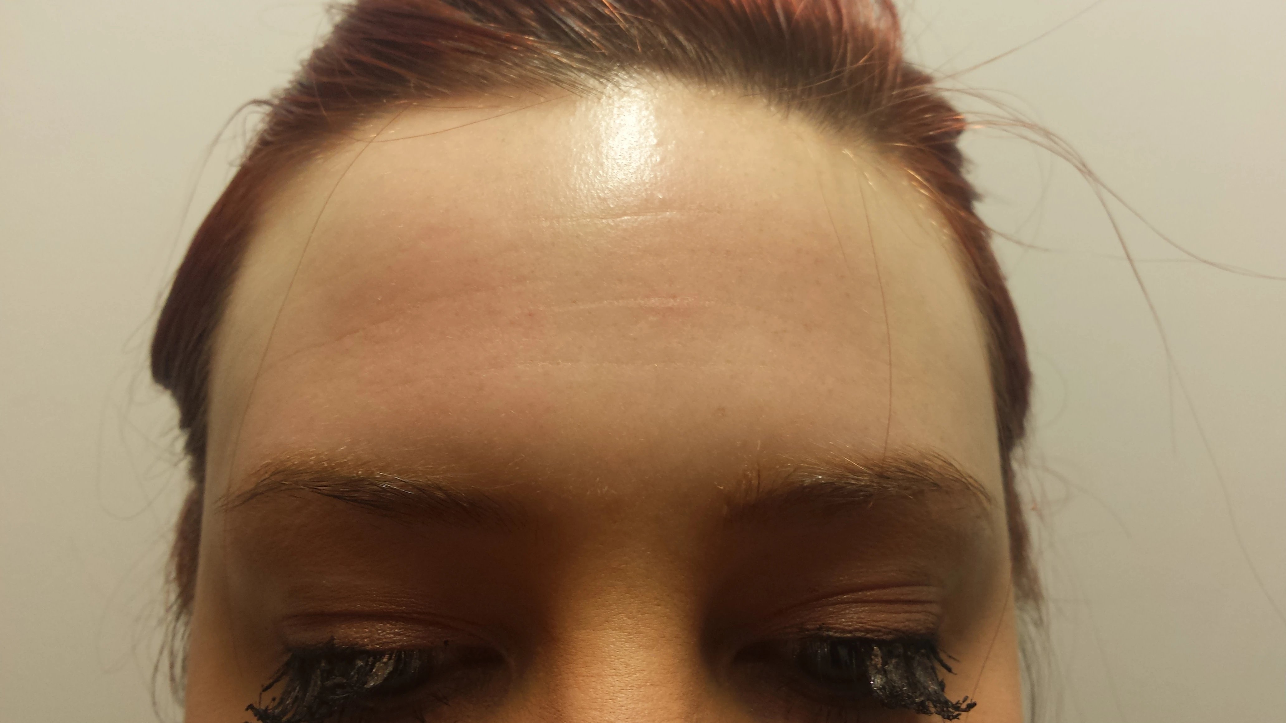 Anti-Wrinkle Injections after