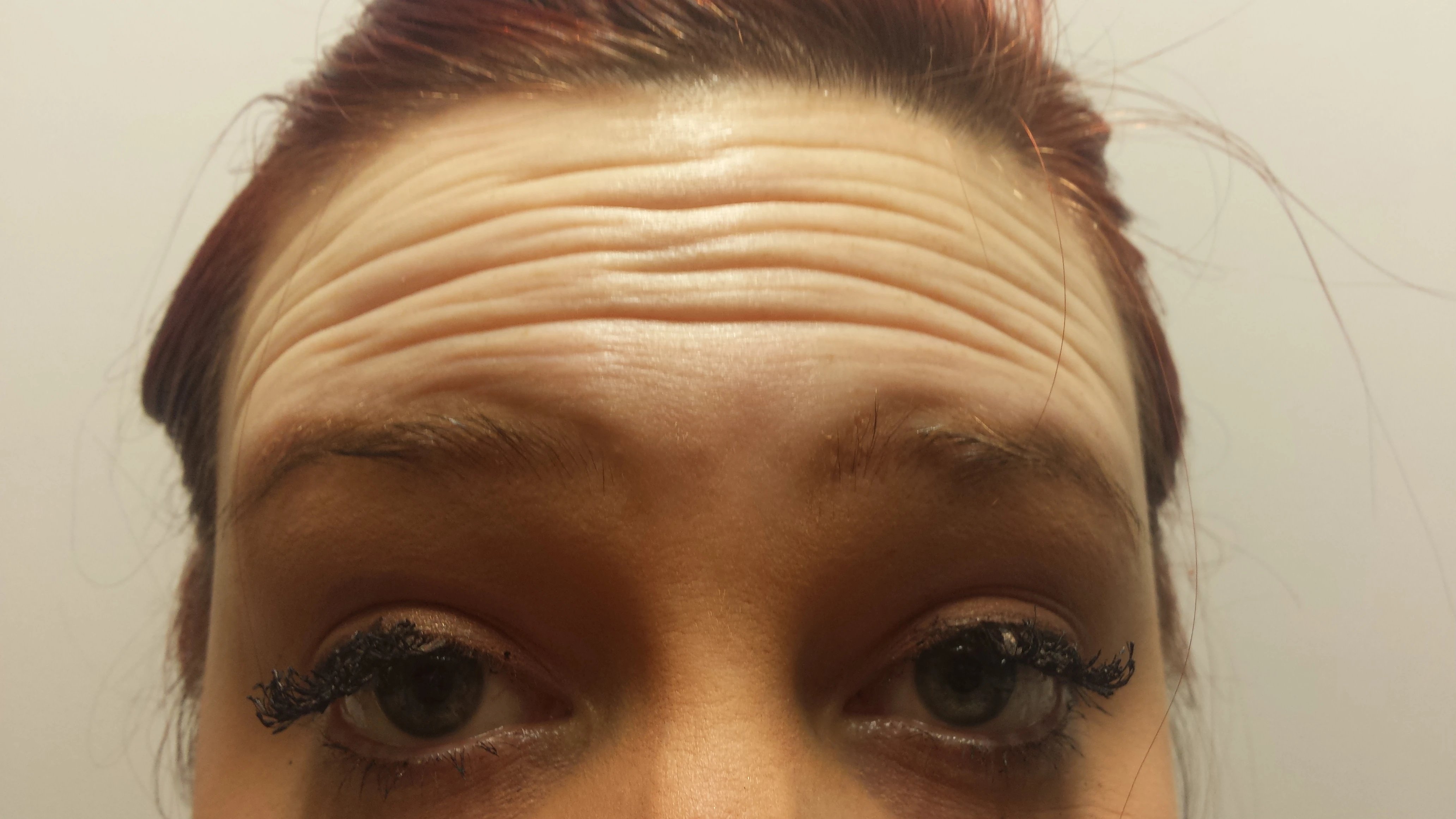 Anti-Wrinkle Injections before